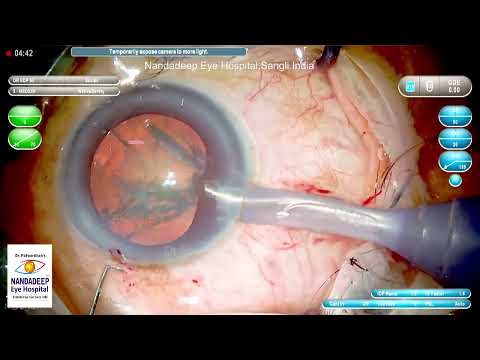 Extreme shallow AC  Dr Sourabh Patwardhan Live Cataract surgery. For training  call 9220001000