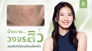 รักษาสิว I EP.4 สิวขึ้นซ้ำ สิวอักเสบเยอะ ต้องคลินิกรักษาสิว l The Vive Clinic