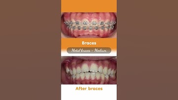 Hành trình LỘT XÁC nhờ niềng răng của Ngọc Trang  #braces #updental