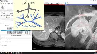 SlicerRVXLiverSegmentation - Segmentation of portal veins