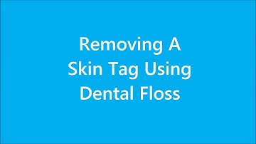 Skin Tag And Mole Removal At Homle Using Dental Floss