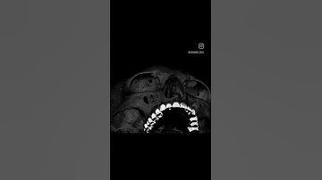 Work to exocad #dental #exocad #ортопедическаястоматология #цифроваястоматология #стоматология