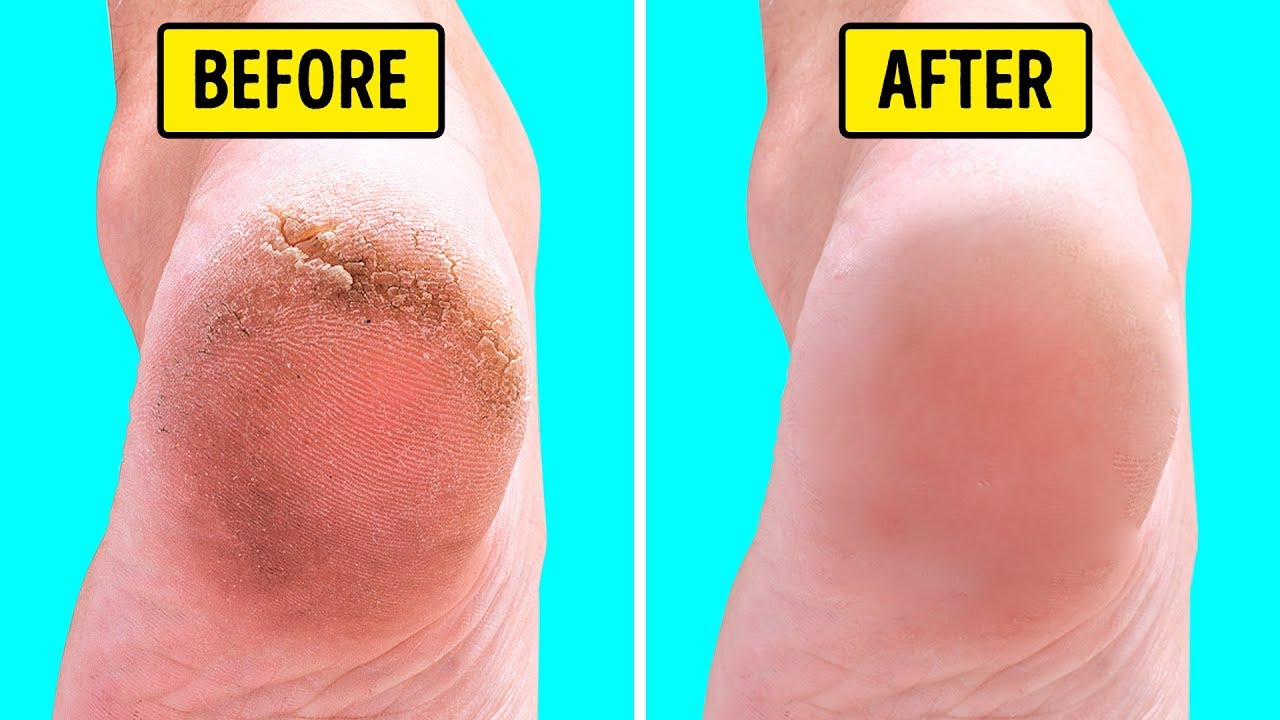 7 Simple Remedies For Cracked Heels – Morpheme Remedies | India