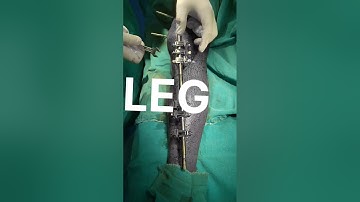 Removal of External Fixator #shorts #trending #viral #doctor #india #orthopaedics #fracture
