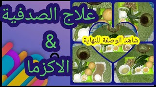 لعلاج الاگزيما والصدفيةوالقوباء/من وصفات أبوعلي الشيباني