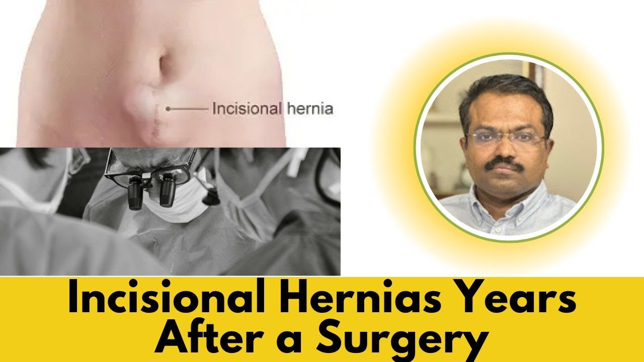 Послеоперационные грыжи спустя годы после операции | Доктор Маран