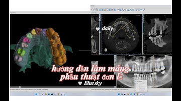 Thiết kế máng hướng dẫn phẫu thuật implant đơn lẻ trên Bluesky - Surgical guide implant