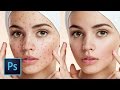 Photoshop Tutorial: The 5 Best Ways to Clean and Heal Skin Blemishes