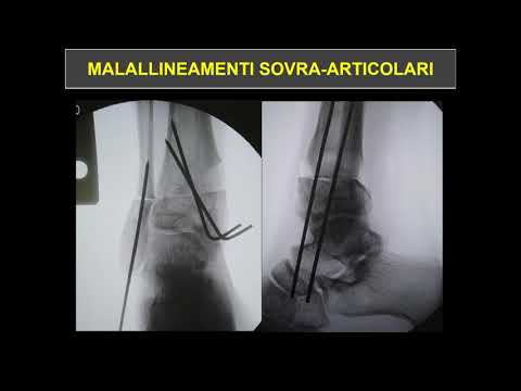 Video: L'effetto Dell'osteotomia Tibiale Ad Alto Cuneo Mediale Aperto Sull'articolazione Rotulofemorale: Analisi Comparativa In Base Allo Stato Di Cartilagine Preesistente
