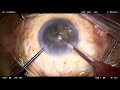 Precision in Femto-Assisted Cataract Surgery Using Vivinex™ Impress Live Surgery by Dr Gaurav Luthra