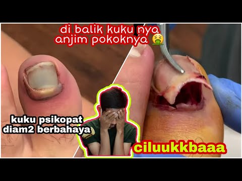 Video: Kemerosotan Kulit, Kuku - Keterangan, Teknik