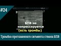 УЗИ вен. Тромбоз протяженного сегмента ствола БПВ