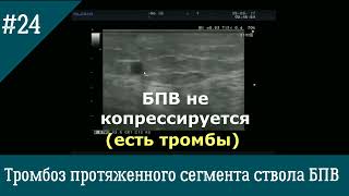 УЗИ вен. Тромбоз протяженного сегмента ствола БПВ