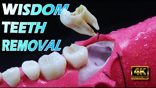 ПОТРЯСАЮЩЕЕ удаление зубов мудрости в 4K | Последующий уход за зубами мудрости