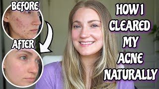 How I Healed My Cystic Acne Naturally (UPDATED) & How You Can Clear Your Acne WITHOUT MEDICATION