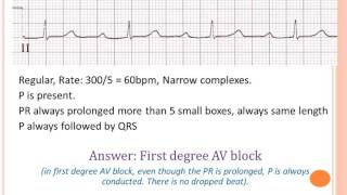 Basic ECG Rhythm Interpretation by Junainah Nor Part 2