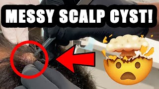 Messy Scalp Cyst