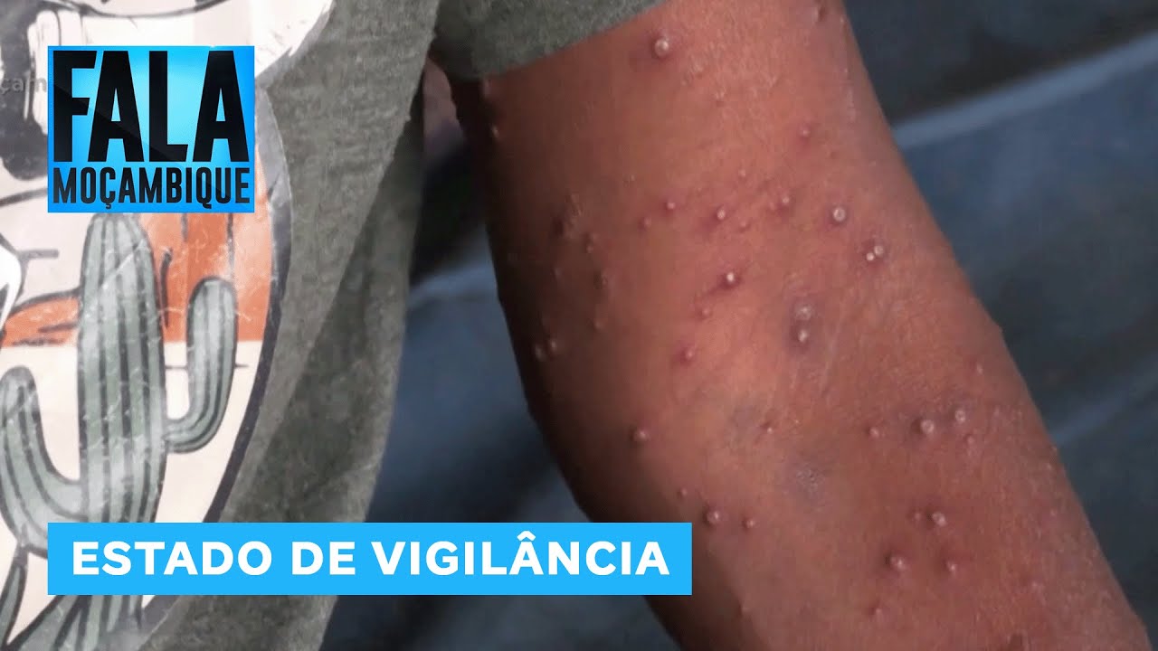 Moçambique notifica 17 casos confirmados de Mpox em menos de 3 semanas @MiramarNews