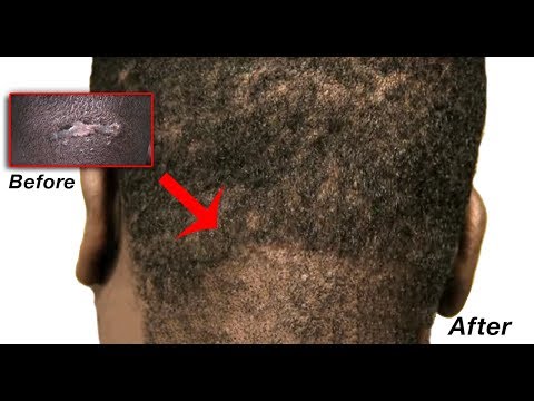 Razor Bumps, Acne Keloid scar ; Acne Keloidalis Nuchae - AKN tricophytic surgical cure by Dr Umar