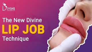 The New Divine Lip Job Technique | Advanced Lip Filler Technique in Divine