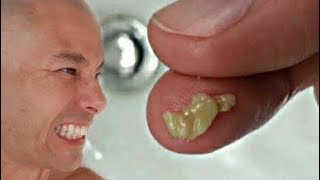 Como Remover Bolinhas Com Mau Cheiro Da Garganta? Dica Infalível