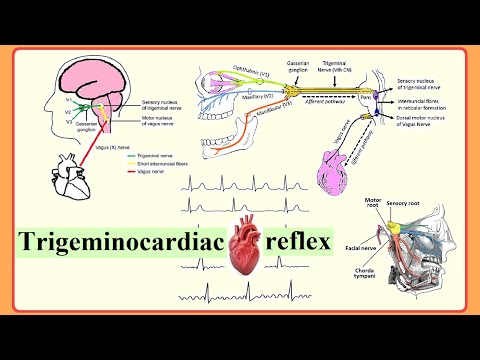 trigeminocardiac reflex