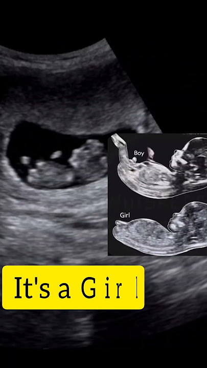It's a baby girl: Nub Theory: Ultrasound case!!