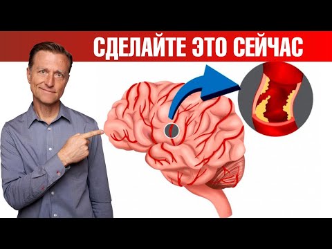 Профилактика инсульта и микроинсульта. Защитите себя ✅