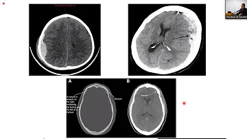 ¿Qué posibilidades hay de sobrevivir a una fractura de cráneo?