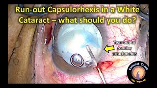 How to Rescue a run-out capsulorhexis with an intumescent white cataract surgery