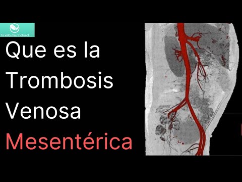 Vídeo: Trombosis De La Arteria Mesentérica: Síntomas Y Tratamiento
