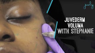 Juvederm Voluma Cheek Filler Treatment With Downtown Columbus Clinical Lead Liz