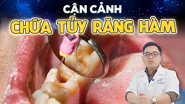 Cận Cảnh Quy Trình Điều Trị Tủy Răng Số 6 - Tránh Nhổ Răng, Hết Viêm Xoang Hàm!