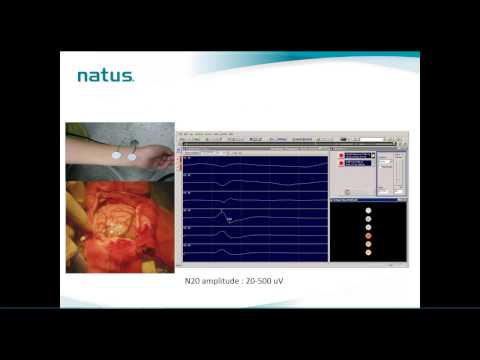 Natus IOM Webinar: Brain Mapping Technique in IOM