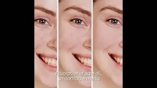 BioAQUA Pure Skin Cream | Remove Acne, Pimples &amp; Dark Spots Naturally ✨