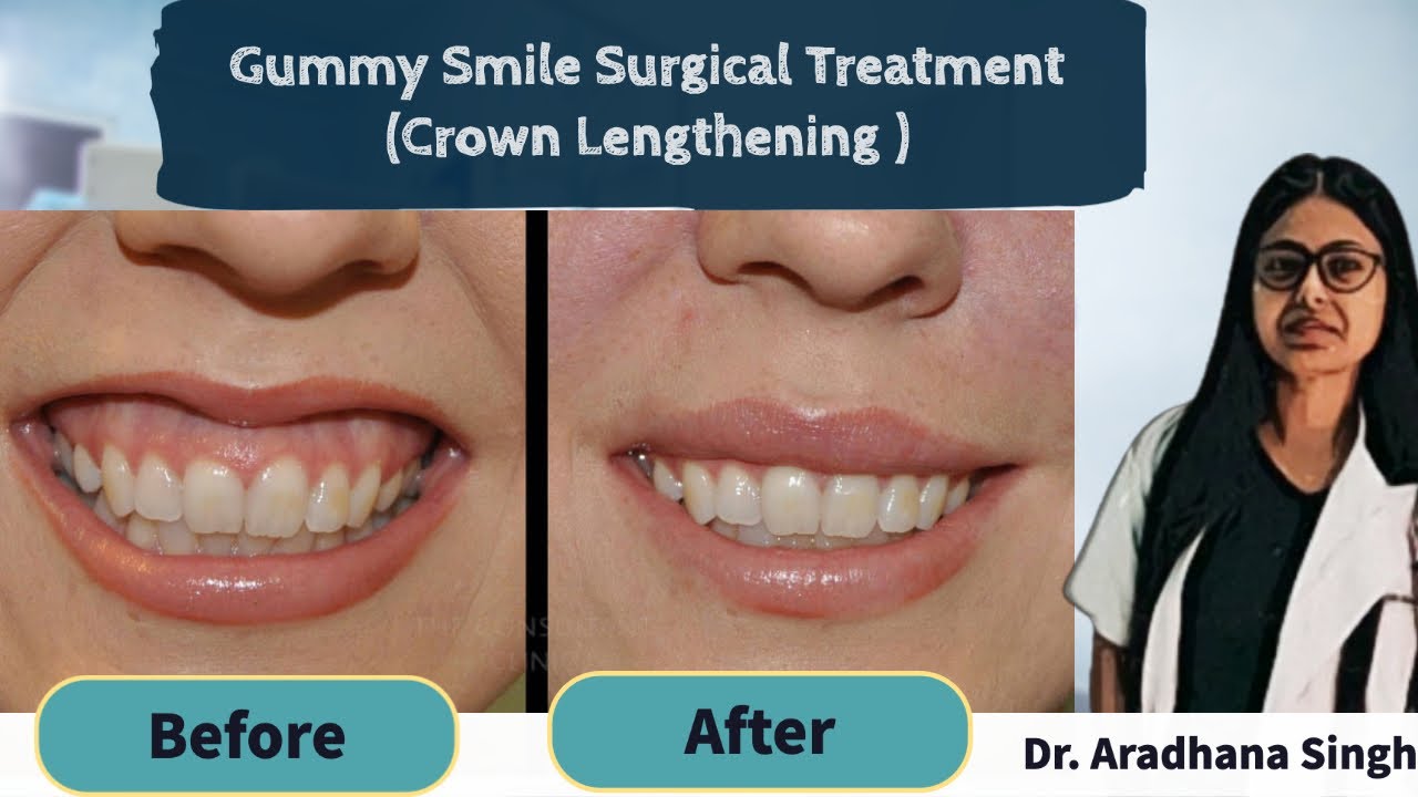 Gummy smile correction Crown Lengthening Gummy smile surgery