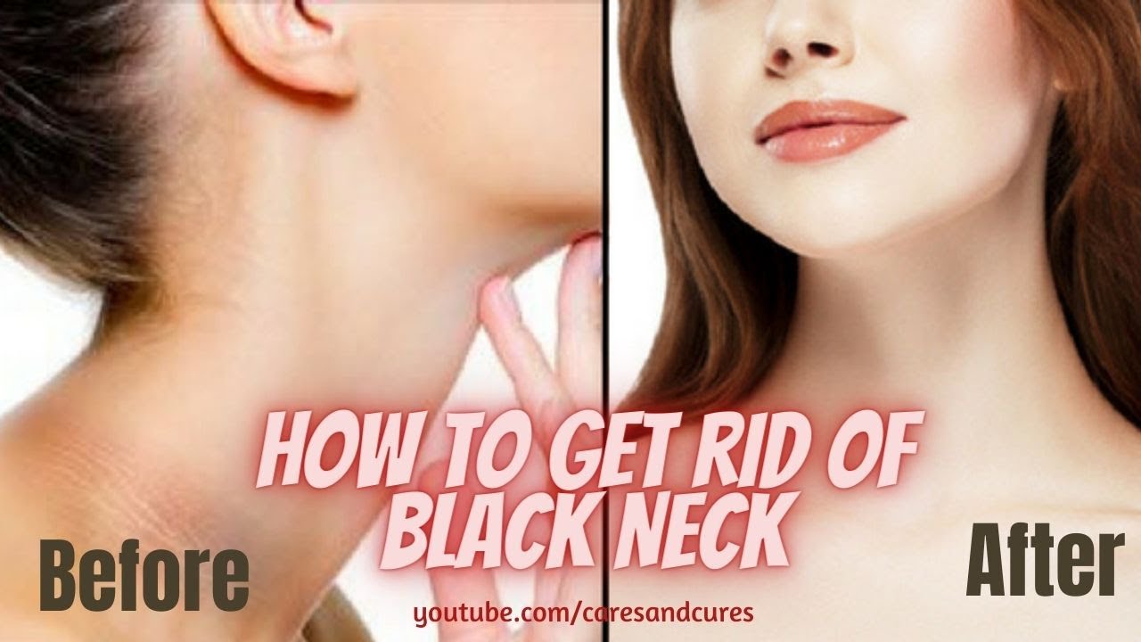 Skin Discoloration On Neck Discoloration On Neck Skin Discoloration