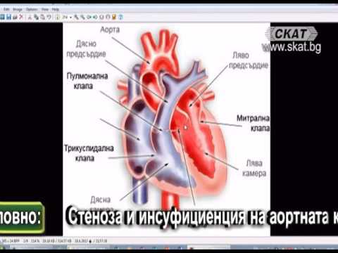 Видео: Аортна склероза - причини, симптоми, усложнения и лечение на аортна склероза