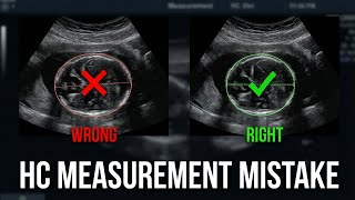 Your Ultrasound HC Measurement Technique Is Probably Wrong