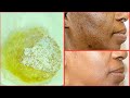 NATURAL EXFOLIATING FACIAL SCRUB FOR CLEARING BLACKHEADS, DARK SPOTS, DULL DRY SKIN, GET CLEAR SKIN