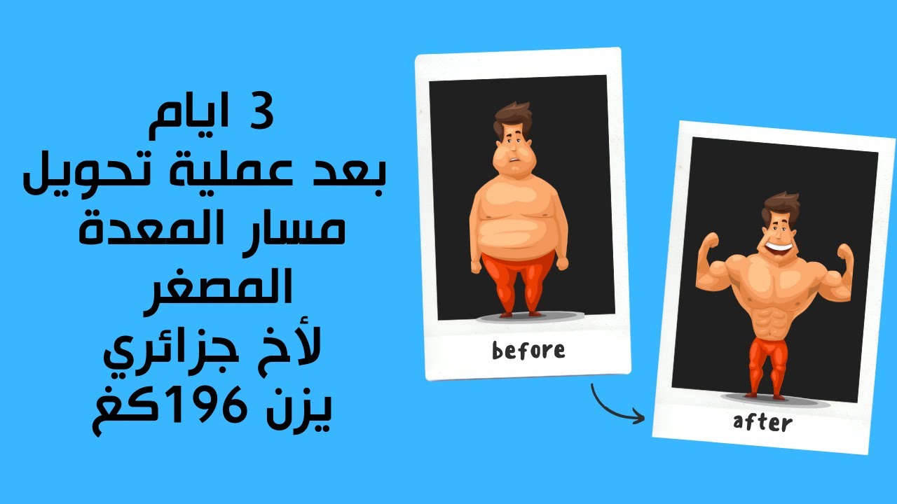 3ايام بعد عملية تحويل مسار المعدة المصغر  لأخ جزائري يزن 196كغ