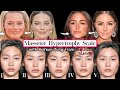 Masseter Botox for Face Slimming |How to Tell if Your're a Good Candidate | Before & Afters