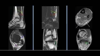 MRI Ankle Case 03