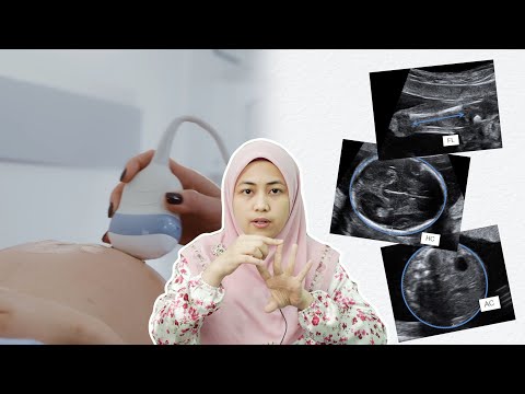 Video: Bolehkah ultrasound mengesan keganasan?