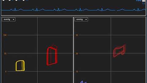 PVloops VAECMO and IABP (Donker DW et al)