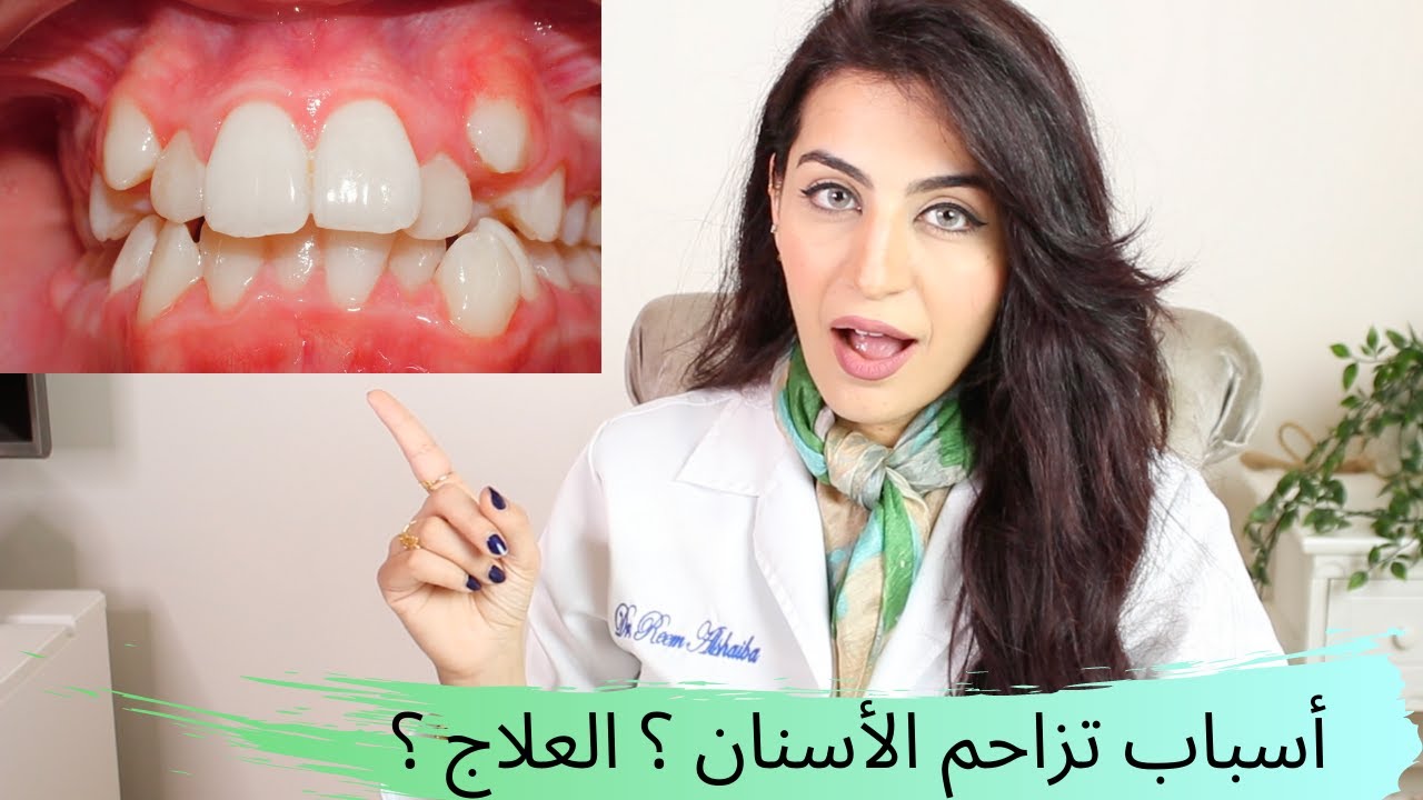 أسباب تزاحم الأسنان ؟ العلاج ؟