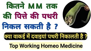 Gall bladder stone | Gall Stones | Homeopathic medicines for gall stones |gallbladder stones maximum