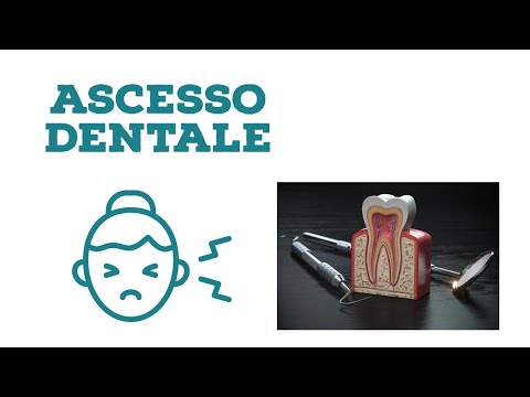 Video: La cellulite periorbitale è un'emergenza?