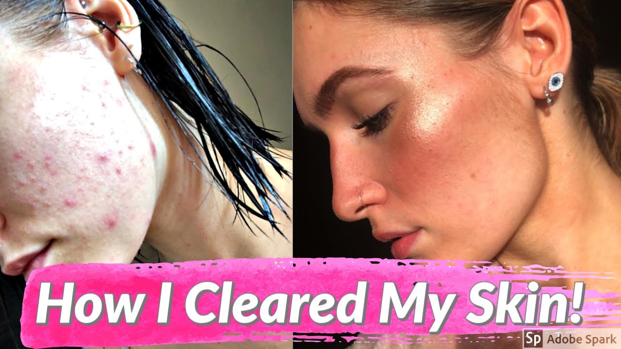 HOW I CLEARED MY ACNE / SKIN TRANSFORMATION! 🤩🌟| Soph & Adam - YouTube