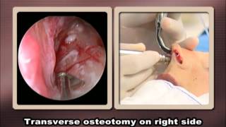 Download Oscillating Micro Saw: A Safe And Pliable Instrument For Transverse Osteotomy In Video MP3 Oscillating Micro Saw: A Safe And Pliable Instrument For Transverse Osteotomy In